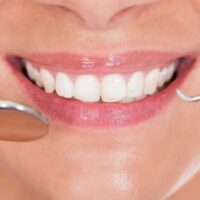 clinica-w-odonto-lentes-de-contato-1
