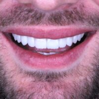 clinica-w-sorriso-lentes clinica-w-sorriso-lentes