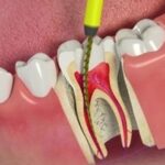 endodontia-canal-clinica-w