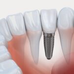 implantes-dentarios-clinica-w