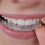 invisalign-clinica-w