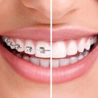 woman teeth and smile. Close up,half with braces